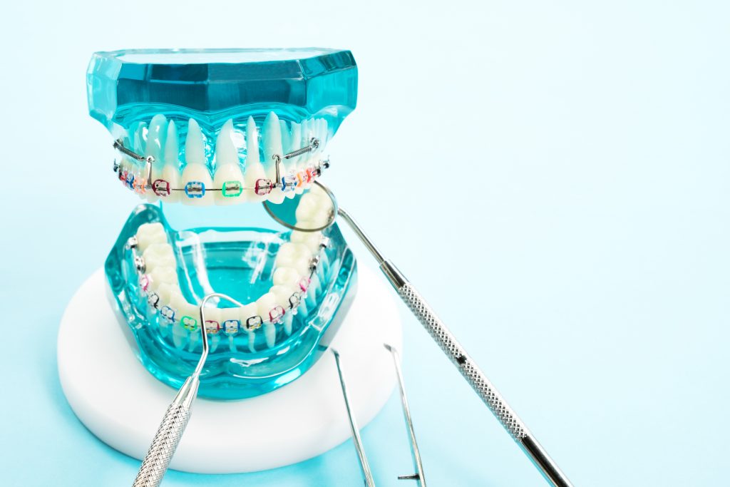 Orthodontic Rubber Bands in Spring, League City, & Cypress, TX